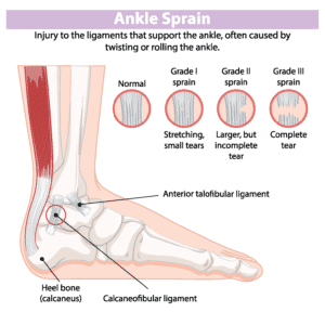 Grades of ankle sprains