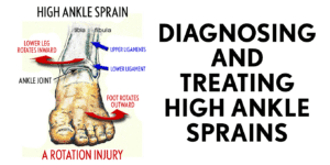 diagnosing and treating high ankle sprains