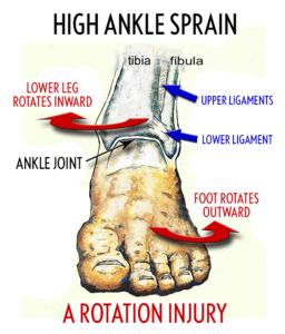how a high ankle sprain works