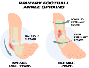 football ankle sprain, inversion ankle sprain, high ankle sprain
