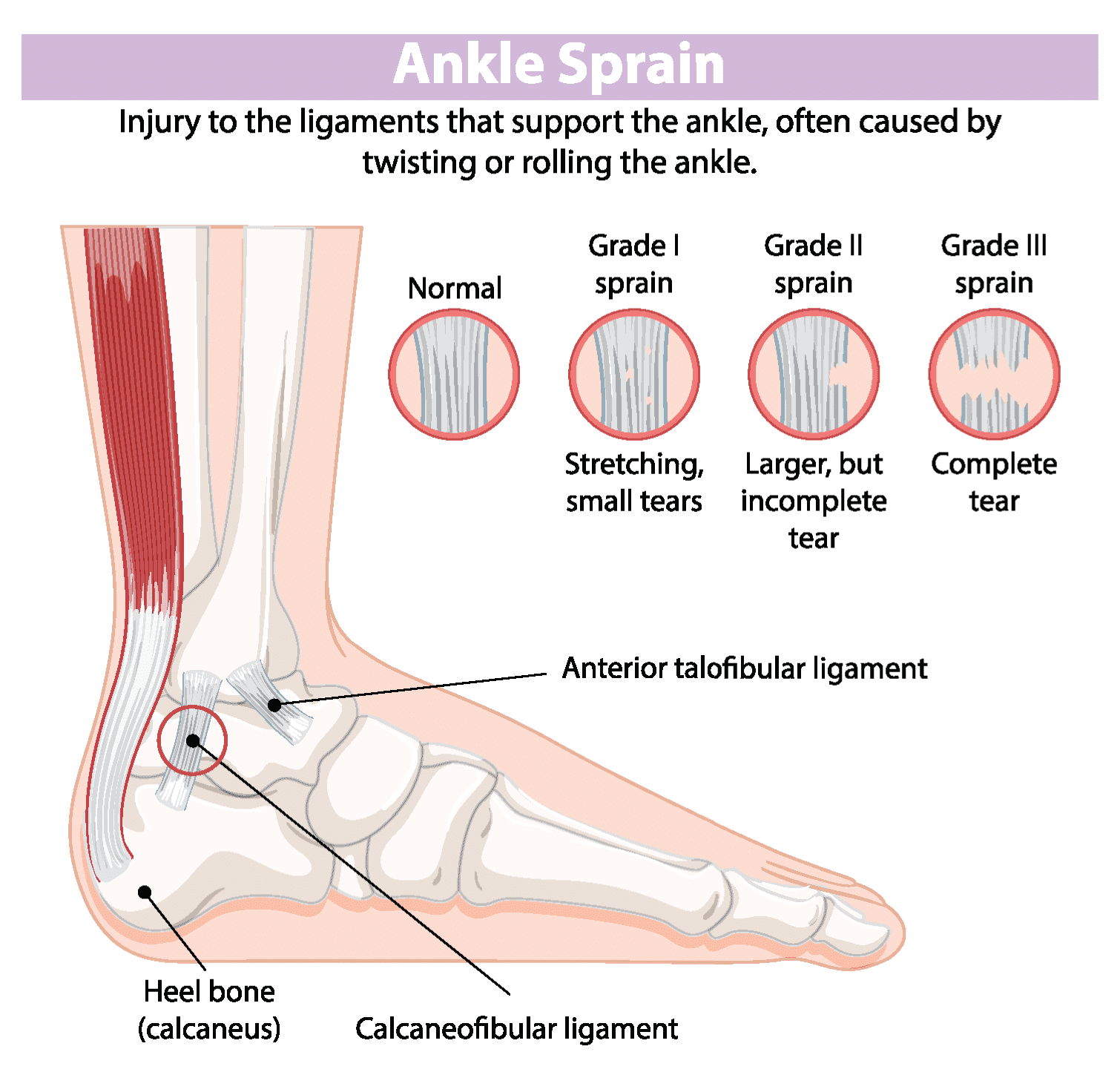 Ankle Injury? Recover Faster - Get Back in the Game Sooner | Ultra Ankle